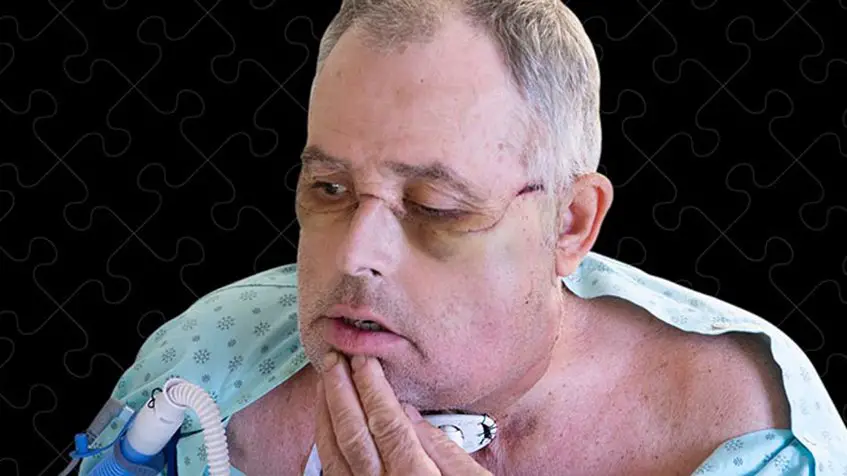  Médicos de Montreal realizaron primer trasplante de cara en Canadá