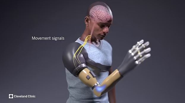 Científicos desarrollan brazo biónico que permite a amputados sentir objetos