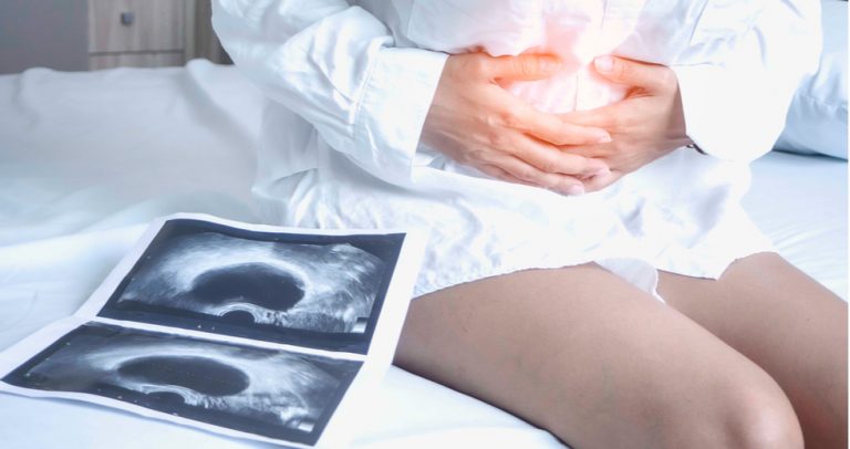 Los secretos de la endometriosis como enemigo de la fertilidad