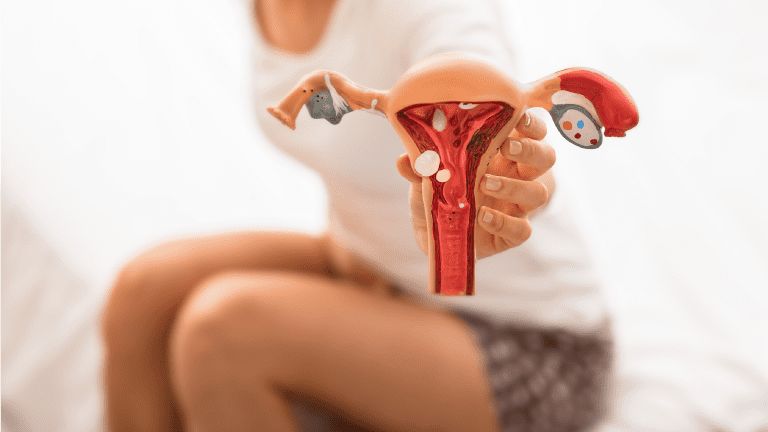 Endometriosis-afectaciones-fertilidad