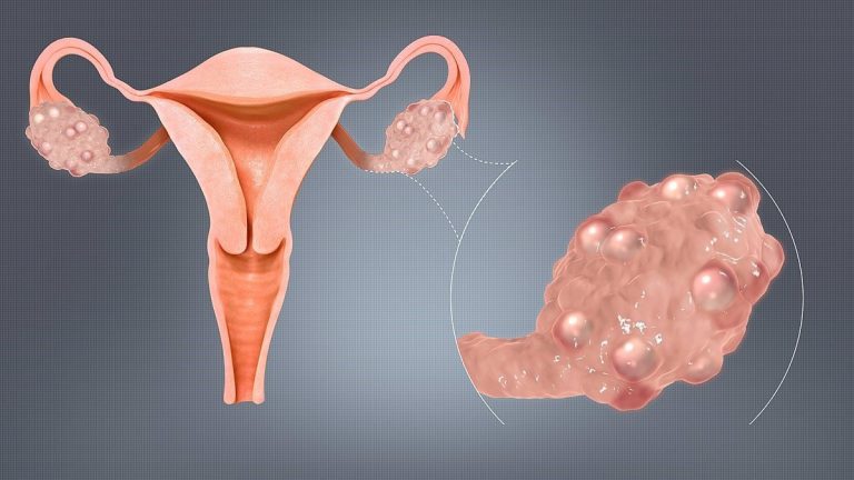 40 % de casos de Síndrome de Ovario poliquístico en mujeres delgadas