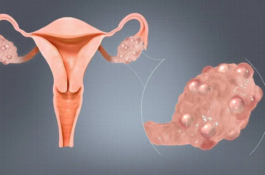  40 % de casos de Síndrome de Ovario poliquístico en mujeres delgadas