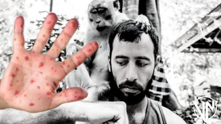 Academia de Medicina sobre viruela del mono:«No hay motivo para alarma en Venezuela”