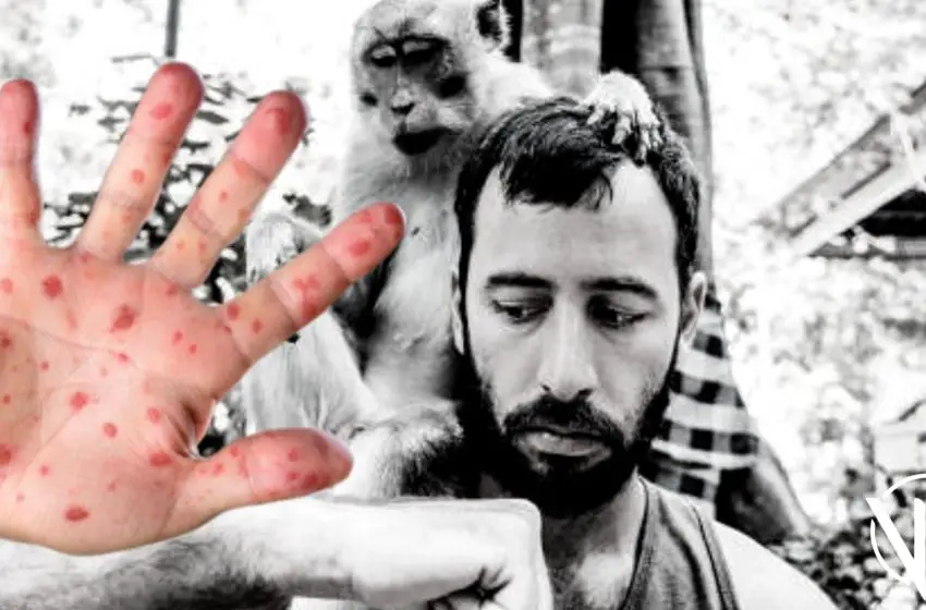  Academia de Medicina sobre viruela del mono:«No hay motivo para alarma en Venezuela»