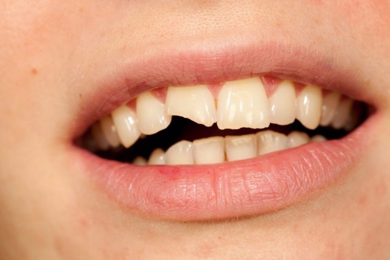 ¿Qué hacer cuando el niño se golpea los dientes?