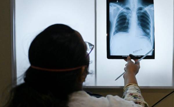 La tuberculosis se propaga en el mundo, advierte la OMS