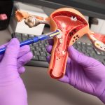 Control ginecológico anual, clave para prevenir el cáncer de cuello uterino