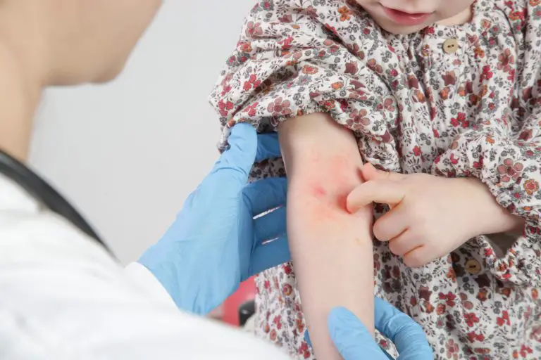 Por qué los niños con dermatitis atópica podrían necesitar más pruebas de alergia