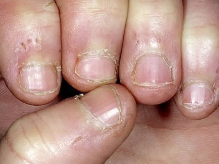Toma nota| Estas son las consecuencias de comerse las uñas