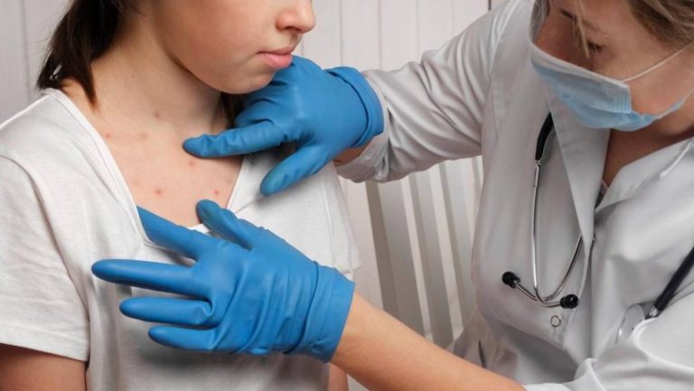 OMS advierte de “alto riesgo” por brotes de sarampión este año