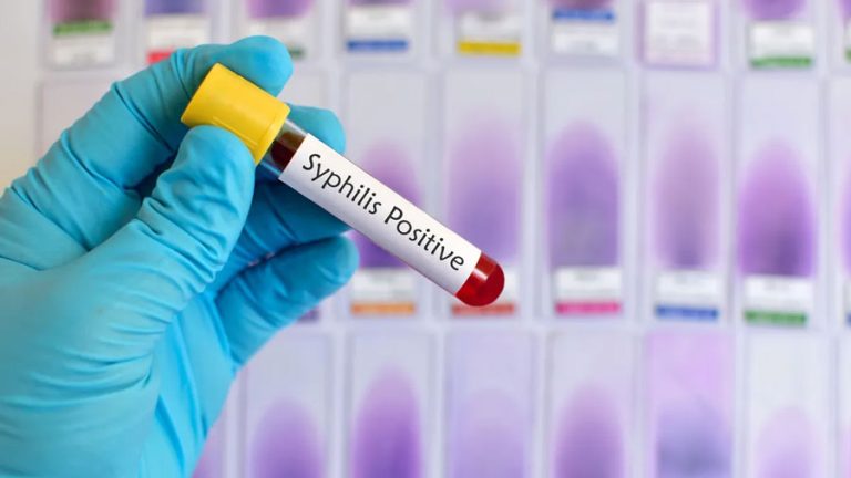 Epidemia de sífilis aumenta su impacto en Estados Unidos