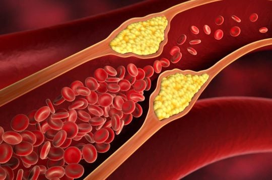 Cinco síntomas del colesterol alto que no debes ignorar