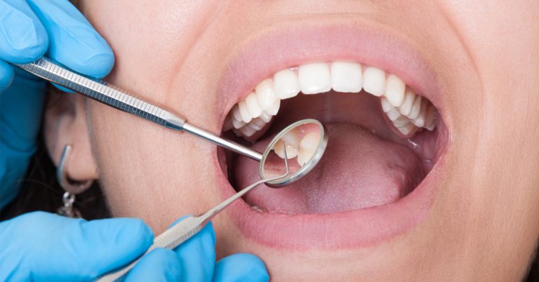 Caries | Remedios naturales para combatirlas