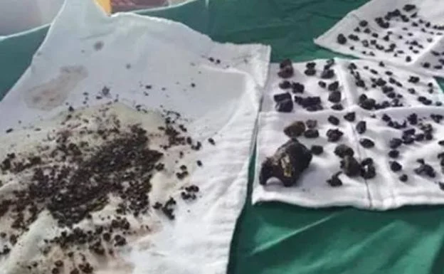 Le extraen casi 100 cálculos biliares tras años saltándose el desayuno