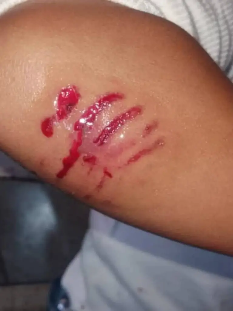 Niña de 5 años es mordida por un pitbull en Coro