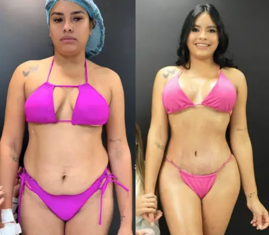 La influencer venezolana, Andreina Perdomo, conocida por mucho como "Isandrep" reveló los cambios físicos tras una cirugía estética.