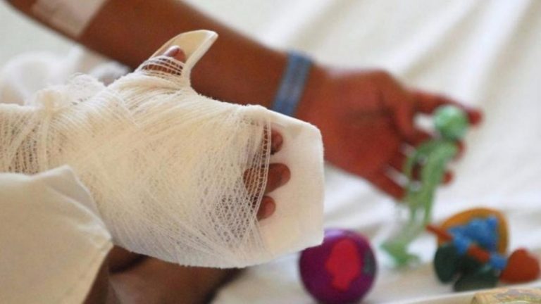 Niña se quemó con agua caliente en Punto Fijo