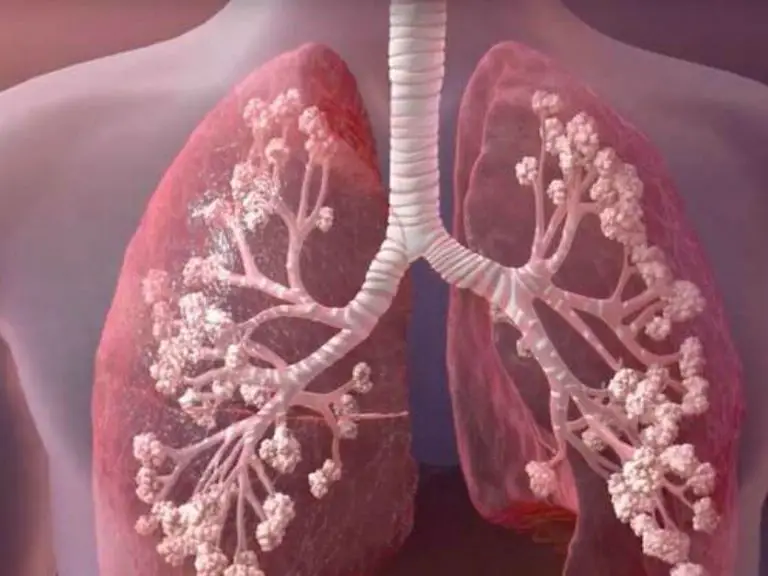 Fibrosis quística, enfermedad genética